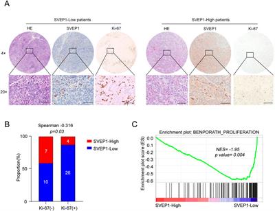 The impact of decreased expression of SVEP1 on abnormal neovascularization and poor prognosis in patients with intrahepatic cholangiocarcinoma